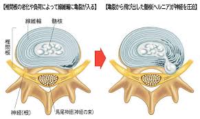 椎間板ヘルニアの形態による分類