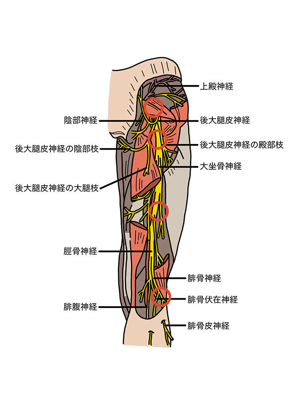 梨状筋症候群