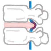 MRIで異常なしと言われたが腰が痛い