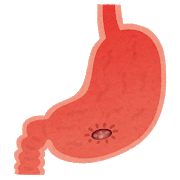 胃潰瘍に痛み止めを飲んで良い？