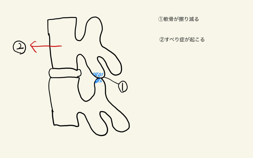 すべり症は治るの？